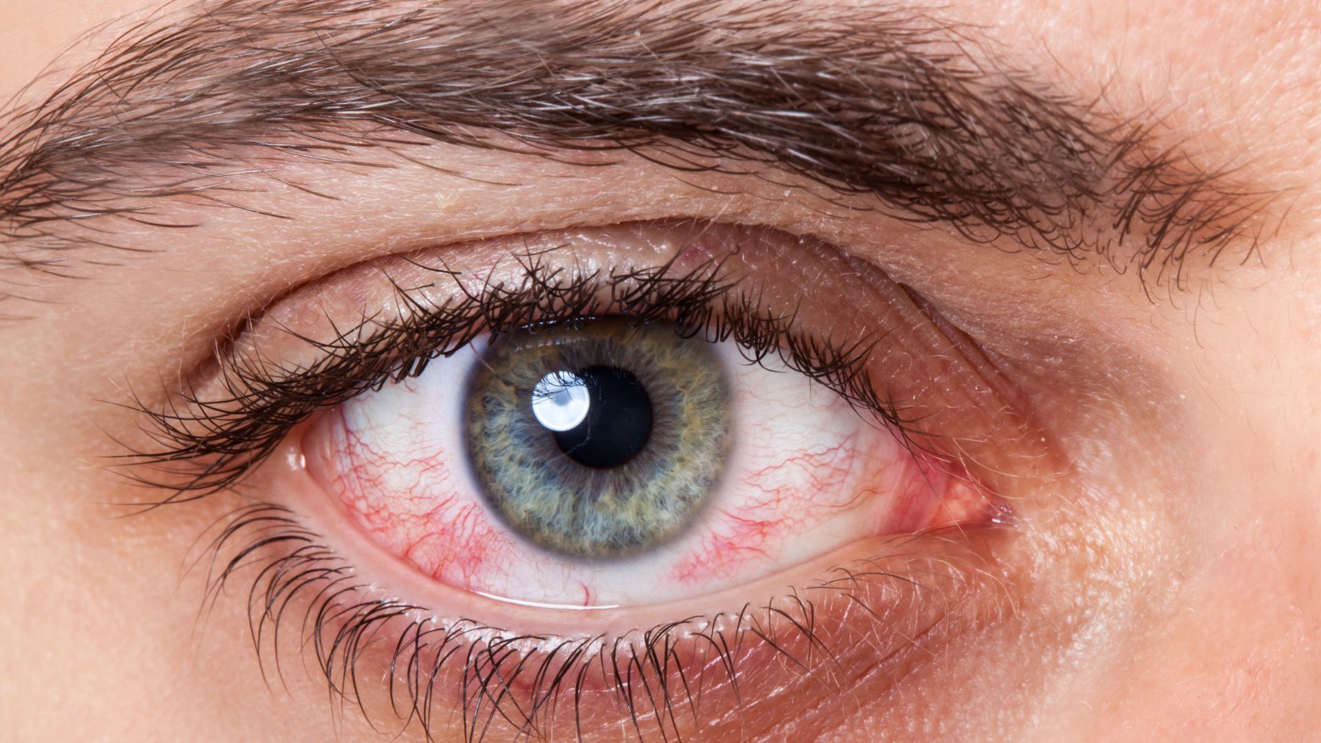 Conheça os sintomas do olho seco